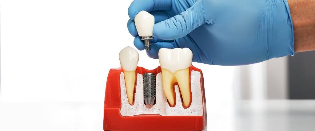 Complete dental implant model.