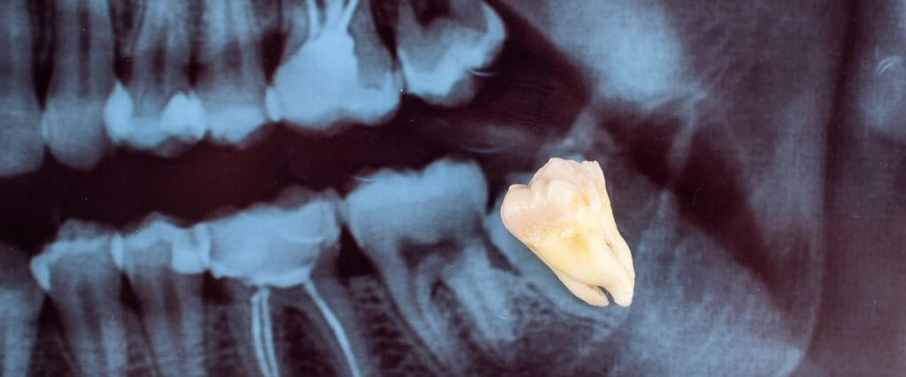 Everything You Need to Know About Wisdom Teeth Removal: Signs, Procedure, and Recovery