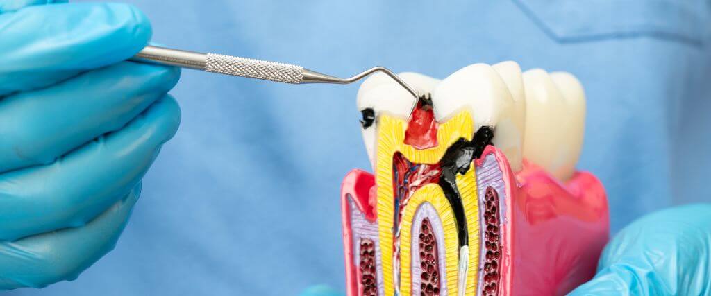 Root Canal Treatment FAQs: Common Patient Concerns and Clear Answers