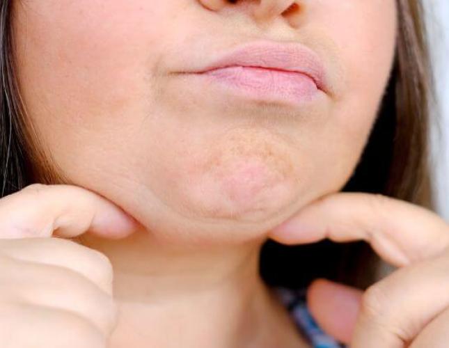 Chin Up! A Complete Guide to Chin Ptosis