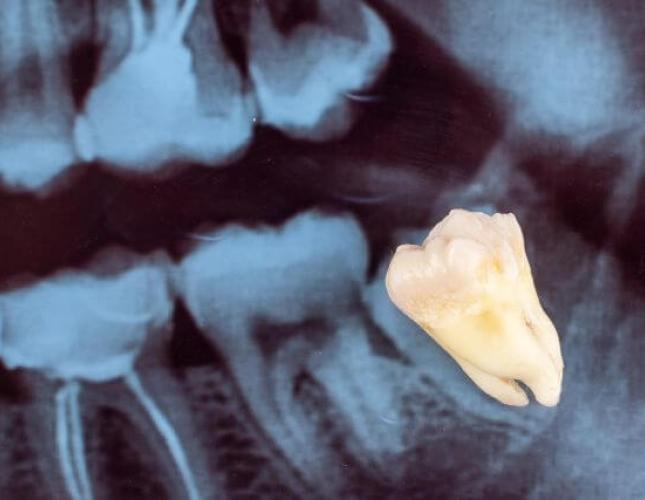 Everything You Need to Know About Wisdom Teeth Removal: Signs, Procedure, and Recovery